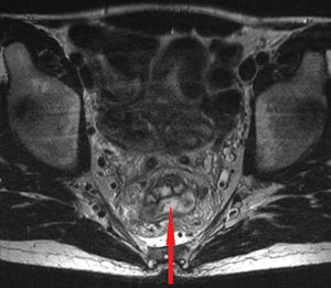 Resonancia magnética pélvica con engrosamiento transmural de la mucosa rectal.