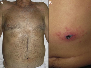 A) Exantema y escara de inoculación. B) Placa de aspecto necrótico, aislada y rodeada por escasas pápulas eritematosas.