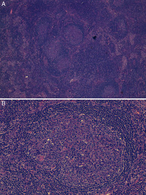 Visión global (A) y en detalle (B) de biopsia ganglionar mostrando adenitis inespecífica en ausencia de gérmenes.