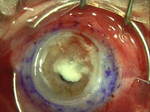 Image taken during surgery prior to the completion of penetrating keratoplasty. Corneal melting is observed with full involvement of all corneal layers and in all quadrants of the ocular fundus, including severe mixed conjunctival hyperaemia.