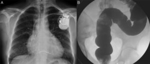 Manifestaciones clínicas de la enfermedad de Chagas. A) Paciente con miocardiopatía chagásica y portador de marcapasos (radiografía de tórax). B) Paciente con megacolon chagásico (enema opaco).