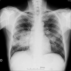 Radiografía de tórax tras 2meses de tratamiento antirretroviral.