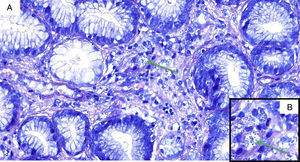 A) Tinción con Giemsa (×40) de biopsia de úlcera gástrica. La flecha señala amastigotes de Leishmania. B) La imagen muestra amastigotes de Leishmania a mayor aumento (×60).