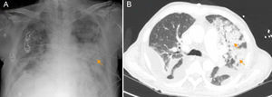 A) Radiografía de tórax con consolidación bilateral, predominio izquierdo (flecha). B) En TAC de tórax se evidencian varias zonas de consolidación parenquimatosa e infiltrados alveolares en LSI y língula compatibles con focos bronconeumónicos (flechas) además de derrame pleural bilateral.