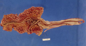 Presencia de adultos de Ascaris lumbricoides en una pieza de tejido intestinal de un paciente con obstrucción secundaria a una infestación masiva.