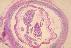 Detalle de una sección de un apéndice de un paciente con un cuadro agudo, donde se puede observar la presencia de un Ascaris lumbricoides en el interior del mismo.