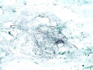 Larvas de Strongyloides stercoralis en el lavado bronquioloalveolar de un paciente inmunodeprimido con un síndrome de hiperinfestación.