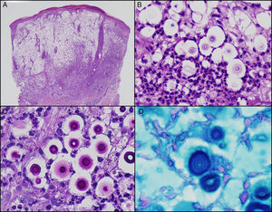 Estudio histológico H&E con intenso componente inflamatorio mixto, agudo y crónico granulomatoso, en relación con abundantes estructuras micóticas esféricas con cápsula (A, 200×; B, 400×). Obsérvese que los microorganismos poseen una pared celular PAS positiva (C, 400×) y una cápsula mucopolisacárida hierro coloidal positiva (D, 400×).