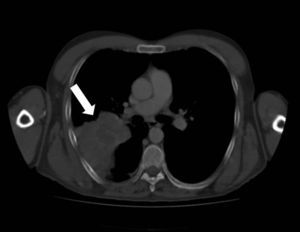 Masa pulmonar parahiliar derecha localizada en el lóbulo superior derecho en la TAC (flecha blanca).