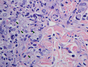 Biopsia cutánea que muestra inflamación granulomatosa con microabscesos de neutrófilos polimorfonucleares. Se identifican en el citoplasma de histiocitos y en dermis, entre el colágeno, numerosas estructuras micóticas similares a las observadas en la biopsia hepática (flechas verdes).