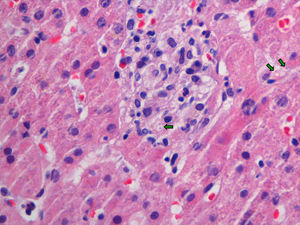 Biopsia hepática que muestra granulomas de predominio lobulillar, sin necrosis ni células gigantes multinucleadas, donde se identifican hongos levaduriformes, de < 5 mm y cápsula fina (flechas verdes).