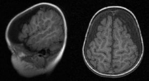 Corte sagital y axial de la RMN cerebral (secuencia T1).