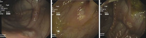 Lesiones ulcerosas circunferenciales superficiales cubiertas de fibrina en colon ascendente y ciego, con zonas adyacentes de mucosa aparentemente sana.