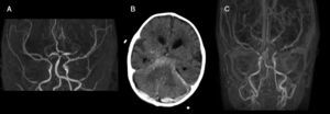 A) Imagen coronal de angio-resonancia magnética: estenosis y dilataciones (string of bead) en las arterias cerebral media y basilar. B) TC: hemorragia subaracnoidea y subdural. C) Angio-resonancia con contraste: aneurisma de la arteria basilar.