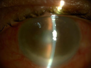 Aspecto inicial de endoftalmitis tras inyección intravítrea. Edema corneal, infiltrado en cámara anterior e hipopión.