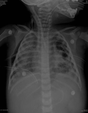 Radiologic examination at day 7, at the time of starting ECMO.