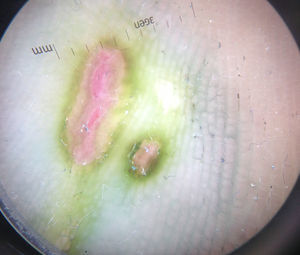Imagen dermatoscópica de las úlceras. Se pueden apreciar 2 ulceraciones de bordes queratósicos de color verde botella. En la periferia, la pigmentación es azulada y adopta un patrón paralelo del surco y en celosía.