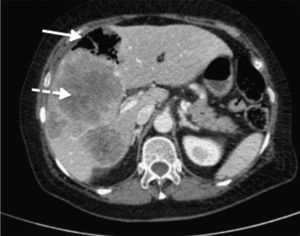 TC de abdomen con contraste intravenoso, plano axial. Lesiones hepáticas metastásicas múltiples (flecha discontinua), una de ellas abscesificada con gas en su interior (flecha continua).