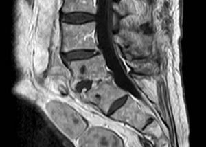 Magnetic resonance imaging of the spine of a 79-year-old patient with infection due to Aerococcus urinae. This sagittal image of the lumbar spine demonstrates the classic appearance of a disk space infection at L4-L5.