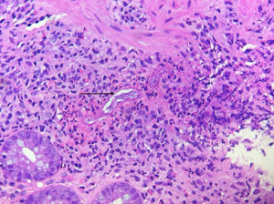 Biopsia de colon (caso 2) que muestra larvas de Strongyloides (flecha).
