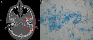 Principales elementos diagnósticos de la otitis externa por Scopulariopsis brevicaulis. A) TAC craneal donde se observan ocupación mastoidea y condritis del CAE, en el lado izquierdo. B) Visualización con azul de lactofenol (×40) de cultivo de 7 días de incubación: conidias esféricas de base truncada dispuestas en cadenas.
