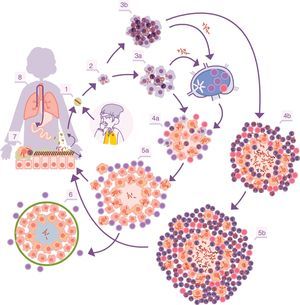 Ciclo infectivo de M. tuberculosis. 1. Entrada de bacilos al alvéolo pulmonar a través de una gota de aerosol. 2. Fagocitosis por parte de un macrófago alveolar (MA) y posterior multiplicación en su interior. 3. Destrucción del MA, diseminación local de M. tuberculosis, fagocitosis por parte de otros MA y generación de una respuesta inflamatoria local dominada por monocitos (3a) o PMN (3b), merced a la cual los bacilos pueden ser drenados hacia el ganglio linfático regional, donde proliferan linfocitos Th1 o Th17. 4. Los linfocitos son atraídos por la respuesta inflamatoria de las lesiones y activan a los MA infectados o atraen más PMN, dependiendo de que la respuesta inmune se decante por una respuesta de tipo Th1 (4a) o Th17 (4b), respectivamente. En el primer caso hay un control de la población bacilar y hay un drenaje de bacilos adormecidos a través de los macrófagos espumosos (5a), hasta que se controla mediante la encapsulación de la lesión (6). En el segundo, las lesiones van creciendo de tamaño gracias a la entrada de PMN y el crecimiento bacilar extracelular en las NET, generando nuevas lesiones periféricas. En este caso, la concentración bacilar es mucho más alta, y de aquí que el drenaje sea mucho más importante, ya sea a través del fluido alveolar o a nivel sistémico mediante la neovascularización del granuloma (5b). A nivel pulmonar los bacilos del fluido alveolar (7) tienden a ser drenados hacia el tracto gastrointestinal (8), aunque pueden formar parte de nuevos aerosoles, generando nuevas lesiones (1). Adaptada de Cardona10.