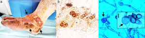 (a) Pigmented verrucous lesions on the foot (arrows), an ulcerative lesion (*) on the lower part of the leg, and yellowish, thick, crusty lesions on the leg are observed. (b) Microscopic examination of scales, showing thick walled, round-to-ovoid brown cells with septa characteristic of fumagoid cells (40×). (c) Microscopic examination with lactophenol blue from primary culture: irregular and pigmented hyphae with internal guttules, chlamydoconidia-like cells and some septate globose structures similar to fumagoid cells (arrows) are observed (scale bar: 10μm).