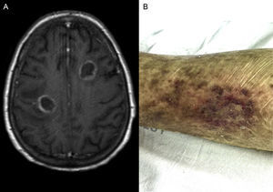Magnetic resonance imaging of the brain (A) and cutaneous lesions (B) noted in patient's left thigh.