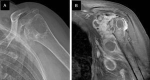 Radiological features of osteoarticular infection of the left shoulder. (A) X-ray demonstrated articular erosive changes, osteopenia and a prominent humeral head cyst. (B) Coronal T1-weighted magnetic resonance images demonstrated profuse articular effusion, osteomyelitis and multiple abscesses in the axillary recess.