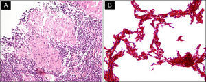 Histological and microbiological features. (A) Tissue biopsy showed caseating granulomas. (B) Cultures of mycobacterium (Ziehl-Neelsen stain), M. tuberculosis smear from MGIT media showing “cord formation”.