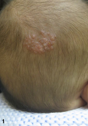 Placa verrugosa formada por múltiples pápulas de aspecto seudoquístico y distribución folicular, localizadas en región parietooccipital derecha.