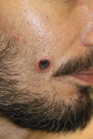 Lesión ulcerada con centro necrótico en la mejilla derecha.