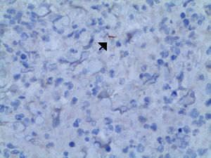 Detección de anticuerpos antitreponema mediante inmunohistoquímica.