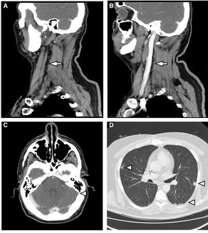 A) Reconstrucción sagital de TCMD con contraste intravenoso. Ausencia de flujo en la vena yugular interna izquierda (flecha). B) Se compara con la vena yugular interna contralateral bien replecionada (flecha). C) TCMD con contraste intravenoso. Ausencia de flujo en seno sagital (punta de flecha). D) TCMD con ventana de pulmón. Se observan múltiples nódulos parenquimatosos de distribución periférica (puntas de flecha).