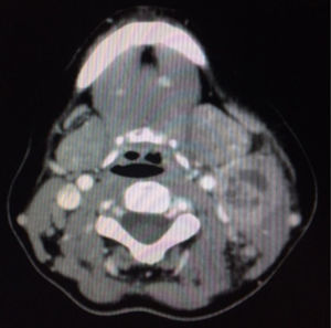 TAC. Masa adenopática, con necrosis central, en espacio cervical izquierdo.
