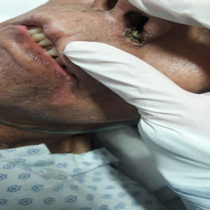 Necrotic lesion in the right nostril compatible with echtyma gangrenosum.