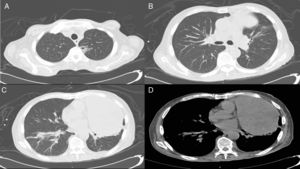 CT scan of the chest. (A) Apical cavitated lesion. (B) Alveolar infiltrate. (C) Basal infiltrate compatible with pneumonia. (D) Nodular heterogeneous mass previously diagnosed as a biphasic synovial sarcoma.