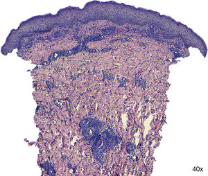 Histopathologic examination revealed only mild dermoepidermal edema and a mixed infiltrate on the dermis without granulomas.