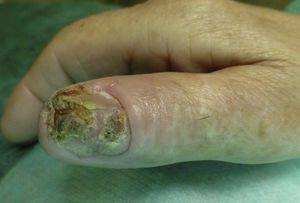 Placa hiperqueratósica que compromete la totalidad del lecho ungueal del primer dedo de la mano derecha.