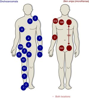 Distribution of onchocercomata and skin snips.