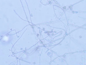 Hifas gruesas e irregulares con conidias hialinas o marrón claro, unicelulares, dispuestas en grupos adosadas a las hifas (tinción azul lactofenol, 400x).