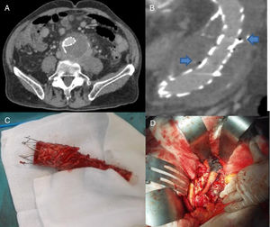 A) Corte coronal de la angio-TC donde se muestra aumento de volumen de los tejidos periaórticos. B) Corte sagital de la angio-TC donde se observan burbujas de gas en el interior del saco aneurismático, rodeando la endoprótesis aórtica. C) Endoprótesis aórtica explantada. D) Imagen intraoperatoria de bypass aorto-uniiliaco derecho con prótesis impregnada en plata.