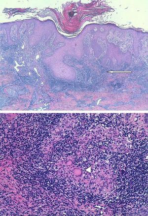 Biopsia punch con hiperplasia escamosa seudoepiteliomatosa. En dermis superficial y media se observa un denso infiltrado inflamatorio linfocítico con formación de frecuentes granulomas (flecha) constituidos por histiocitos y células gigantes multinucleadas de tipo Langhans y de tipo a cuerpo extraño que se encuentran rodeados por una corona de linfocitos (cabeza de flecha). No se observa necrosis central de los mismos.