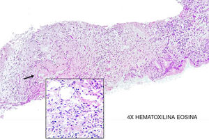 Tinción de hematoxilina eosina con infiltrado inflamatorio de tipo linfohistiocitario con presencia de células gigantes y formación de granulomas (flecha negra).