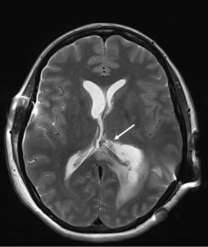 Magnetic resonance image (MRI) showing a multi-septate nodule (white arrow) producing an expansion of the atrium.
