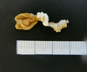 Macroscopic morphology of a nodular structure extracted surgically.
