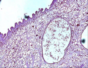 Photomicrograph of hematoxylin and eosin staining of extracted tissue. A microvillous tegument and a reticular matrix with calcareous bodies are detected.