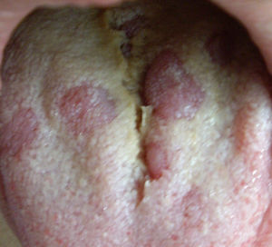 Lesión característica en lengua en paciente con secundarismo sifilítico.