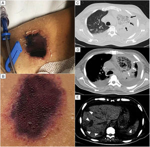 Skin lesion and radiologic findings. (A, B) Necrotic skin lesions located at the right shoulder (shown in the image) and the ventral face of the lower extremities. (C, D) Chest CT scan. The reversed halo sign (arrows), a focal round area of ground-glass attenuation surrounded by a ring of consolidation. (E) Abdomen CT scan. Multiple hypodense nodular lesions in the liver and spleen suggestive of abscesses (arrowheads).