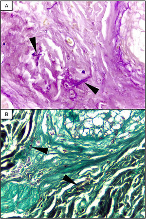 Skin biopsy histopathology. (A) Histopathology of the skin biopsy from the right shoulder. Broad and aseptate hyphae (arrowheads) consistent with Mucor spp., PAS stain, 40×. (B) Grocott stain, 10×.
